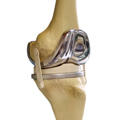 An example of an artificial knee. An example of an artificial knee.
