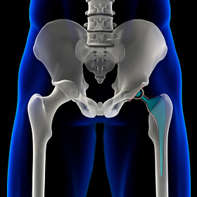 A 3D illustration of an artificial hip. A 3D illustration of an artificial hip.