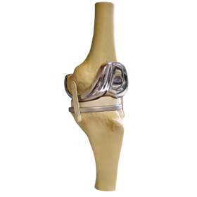 An example of an artificial knee. An example of an artificial knee.