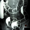 X-ray of the large intestine after a barium enema. X-ray of the large intestine after a barium enema.