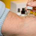 A skin prick test or scratch test. A skin prick test or scratch test.