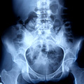 Bone scan test results. Bone scan test results.