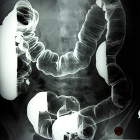 X-ray of the large intestine after a barium enema. X-ray of the large intestine after a barium enema.