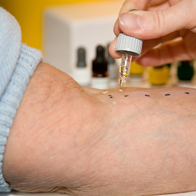 A skin prick test or scratch test. A skin prick test or scratch test.