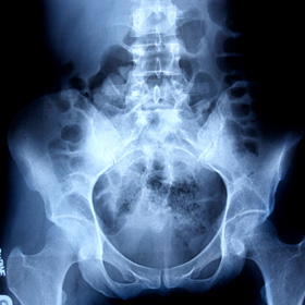 Bone scan test results. Bone scan test results.
