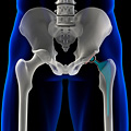 A 3D illustration of an artificial hip.