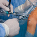 An arthroscopy being performed on a knee joint.