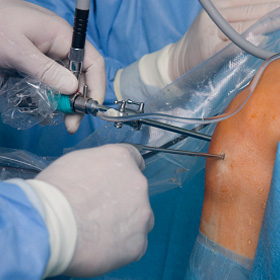 An arthroscopy being performed on a knee joint.