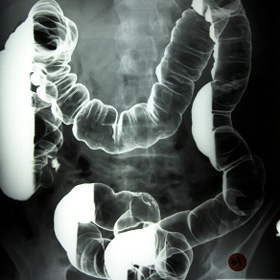 X-ray of the large intestine after a barium enema.