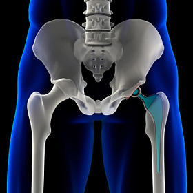 Une illustration tridimensionnelle d'une hanche artificielle.