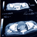 Une tomodensitométrie d'un cancer de la prostate. Une tomodensitométrie d'un cancer de la prostate.
