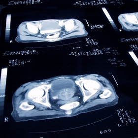 Une tomodensitométrie d'un cancer de la prostate. Une tomodensitométrie d'un cancer de la prostate.